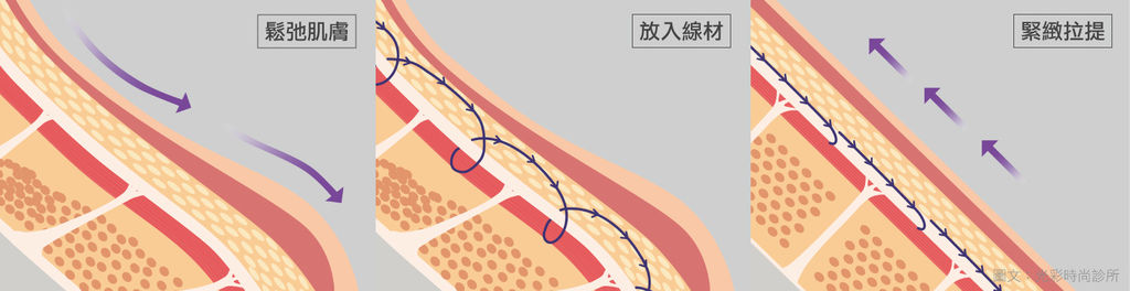 埋線拉提3步驟.jpg