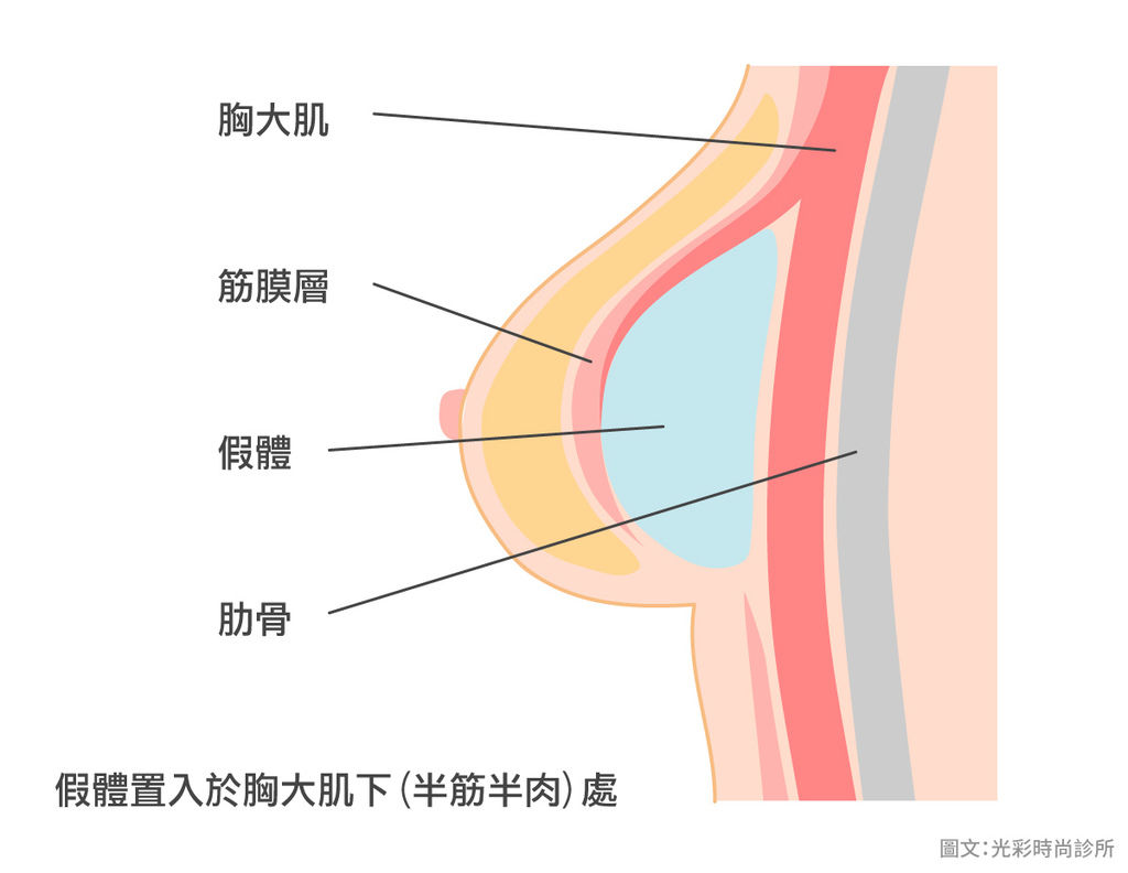 內視鏡隆乳隆乳手術風險水滴形絨毛矽膠隆乳乳房發育隆乳價格豐胸手 術內視鏡光彩時尚診所台北醫美推薦果凍隆乳水滴隆乳