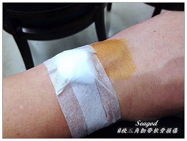 三角韌帶軟骨損傷 三角韌帶軟骨損傷