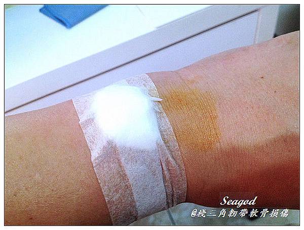 三角韌帶軟骨損傷 三角韌帶軟骨損傷