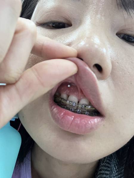 我的牙齒矯正日記-明圳齒顎矯正診所,一段長長的變美之路 我的牙齒矯正日記-明圳齒顎矯正診所,一段長長的變美之路