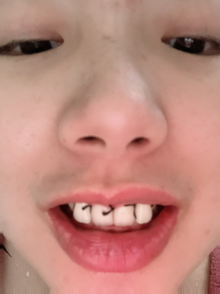 我的牙齒矯正日記-明圳齒顎矯正診所,一段長長的變美之路 我的牙齒矯正日記-明圳齒顎矯正診所,一段長長的變美之路