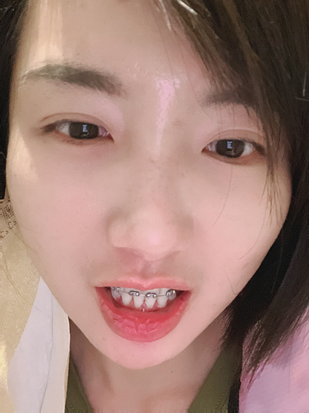 我的牙齒矯正日記-明圳齒顎矯正診所,一段長長的變美之路 我的牙齒矯正日記-明圳齒顎矯正診所,一段長長的變美之路