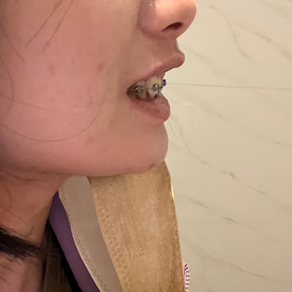 我的牙齒矯正日記-明圳齒顎矯正診所,一段長長的變美之路 我的牙齒矯正日記-明圳齒顎矯正診所,一段長長的變美之路