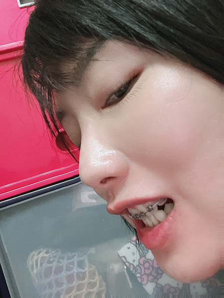 我的牙齒矯正日記-明圳齒顎矯正診所,一段長長的變美之路 我的牙齒矯正日記-明圳齒顎矯正診所,一段長長的變美之路