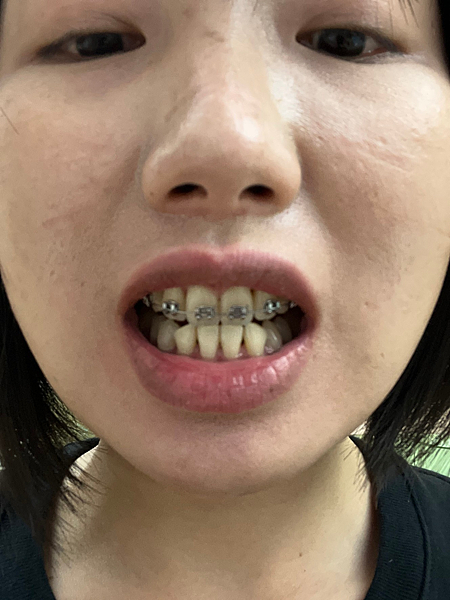 我的牙齒矯正日記-明圳齒顎矯正診所,一段長長的變美之路 我的牙齒矯正日記-明圳齒顎矯正診所,一段長長的變美之路