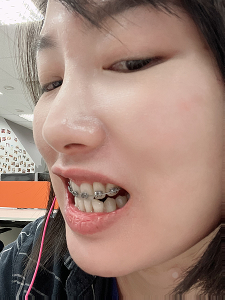 我的牙齒矯正日記-明圳齒顎矯正診所,一段長長的變美之路 我的牙齒矯正日記-明圳齒顎矯正診所,一段長長的變美之路