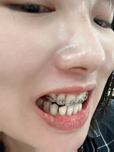我的牙齒矯正日記-明圳齒顎矯正診所,一段長長的變美之路 我的牙齒矯正日記-明圳齒顎矯正診所,一段長長的變美之路