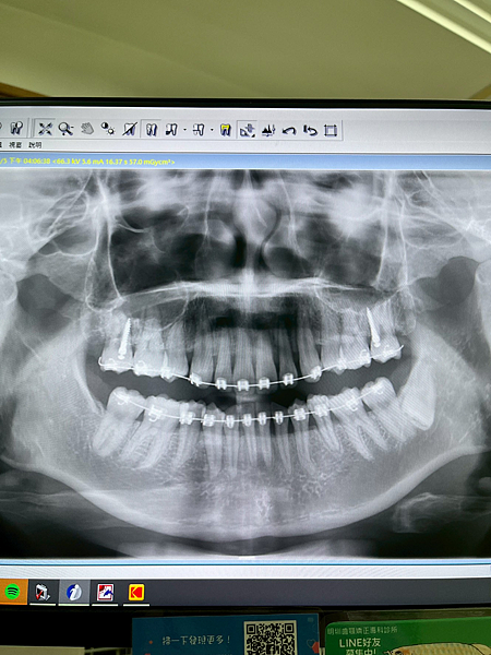 我的牙齒矯正日記-明圳齒顎矯正診所,一段長長的變美之路 我的牙齒矯正日記-明圳齒顎矯正診所,一段長長的變美之路