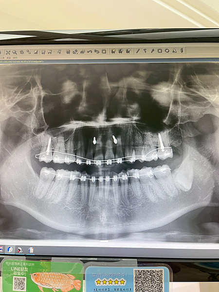 我的牙齒矯正日記-明圳齒顎矯正診所,一段長長的變美之路 我的牙齒矯正日記-明圳齒顎矯正診所,一段長長的變美之路