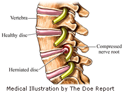 Herniated%20Disc.gif