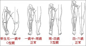 扁平足3