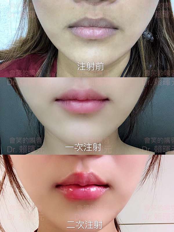 微整 千萬不要用玻尿酸打微笑唇 妳會愛上 七七醫美都做什麼呀 痞客邦