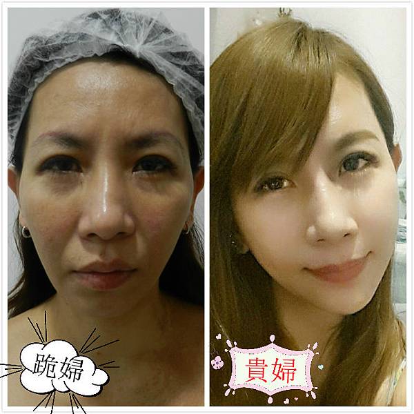 術前後_meitu_1.jpg 術前後_meitu_1.jpg