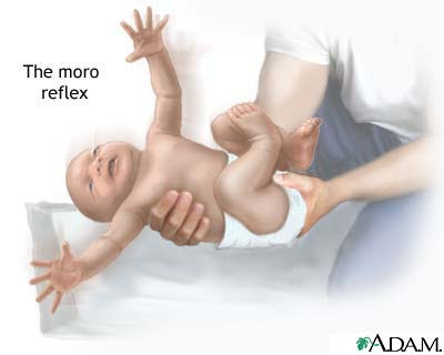 moro-reflex.jpg