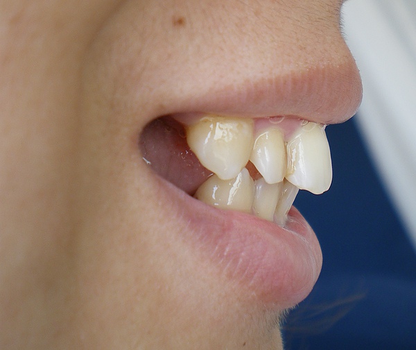 牙套日記 2 戴牙套的原因 Viento 碧安朵 S 博物館 痞客邦