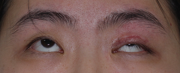 眼整形/提眼肌手術-作者沈筠惇 眼整形/提眼肌手術-作者沈筠惇