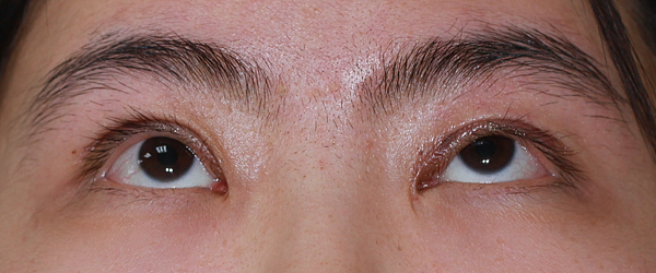 眼整形/提眼肌手術-作者沈筠惇 眼整形/提眼肌手術-作者沈筠惇