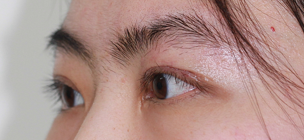 眼整形/提眼肌手術-作者沈筠惇 眼整形/提眼肌手術-作者沈筠惇