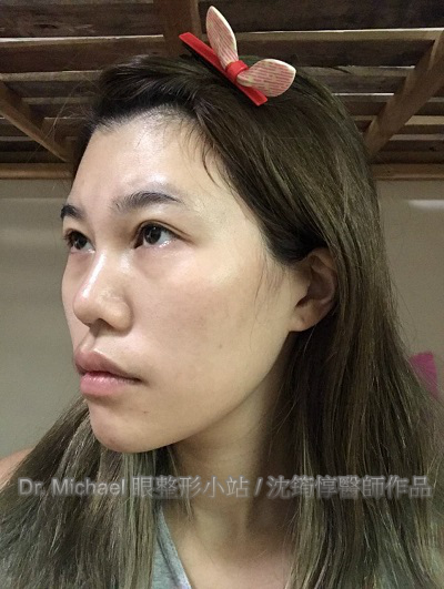 眼整形 x 自體脂肪移植-作者沈筠惇 眼整形 x 自體脂肪移植-作者沈筠惇