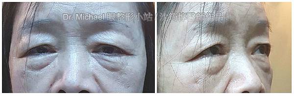 眼整形/眼袋內開/眼袋外開-作者沈筠惇 眼整形/眼袋內開/眼袋外開-作者沈筠惇