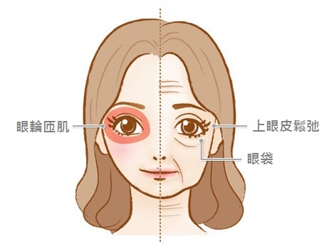 眼整形/眼袋內開/眼袋外開-作者沈筠惇 眼整形/眼袋內開/眼袋外開-作者沈筠惇