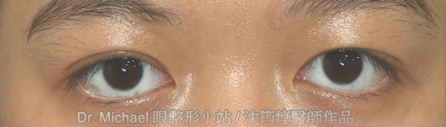 眉下脂肪移除+開放式雙眼皮手術-作者沈筠惇醫師 眉下脂肪移除+開放式雙眼皮手術-作者沈筠惇醫師