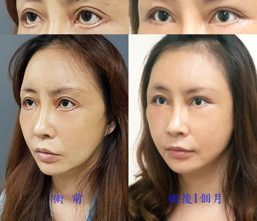 眼袋外翻 / 內視鏡中臉拉皮(作者:Dr.Michael 沈筠惇醫師) 眼袋外翻 / 內視鏡中臉拉皮(作者:Dr.Michael 沈筠惇醫師)