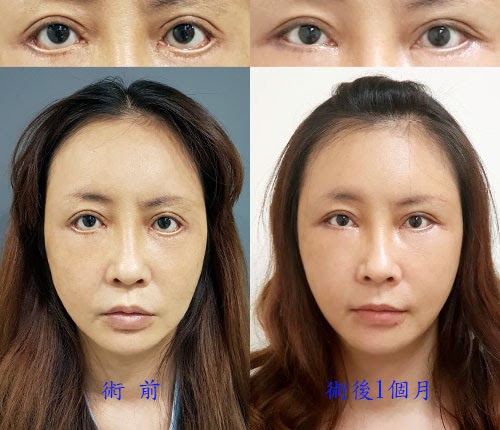 眼袋外翻 / 內視鏡中臉拉皮(作者:Dr.Michael 沈筠惇醫師) 眼袋外翻 / 內視鏡中臉拉皮(作者:Dr.Michael 沈筠惇醫師)