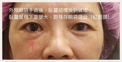眼袋重修手術:臥蠶(眼台)修復和殘餘眼袋消除─作者:DrMichael 沈筠惇醫師 臥蠶修復和殘餘眼袋消除─作者:DrMichael 沈筠惇醫師