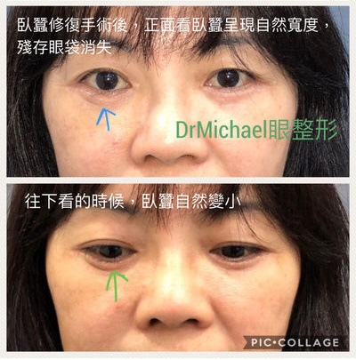 眼袋重修手術:臥蠶(眼台)修復和殘餘眼袋消除─作者:DrMichael 沈筠惇醫師 眼袋重修手術:臥蠶(眼台)修復和殘餘眼袋消除─作者:DrMichael 沈筠惇醫師