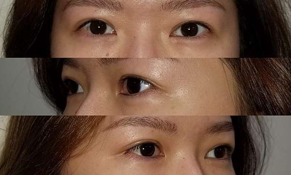 雙眼皮重修 三角眼 如何以雙眼皮手術技術來改善眼尾下垂 三角眼 問題 沈筠惇醫師dr Michael 整形修復藝術 痞客邦