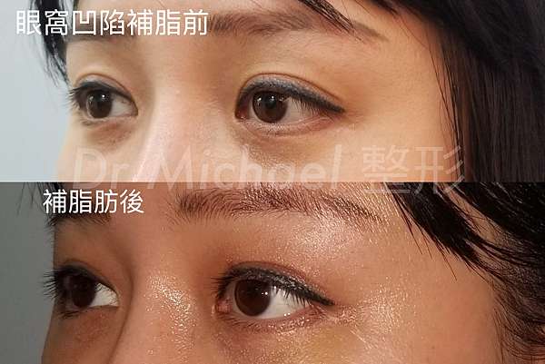 眼窩 脂肪 Article 眼窩 脂肪 Article