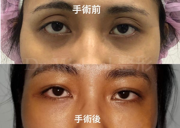 眼窩 脂肪 Article 眼窩 脂肪 Article