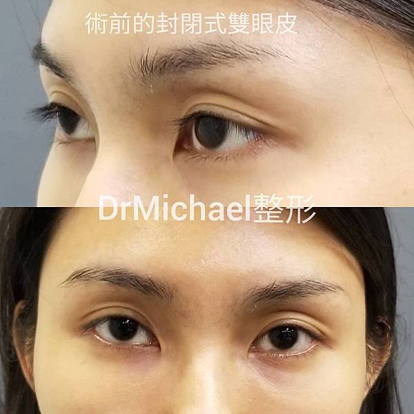 沈筠惇醫師dr Michael 整形修復藝術 痞客邦 沈筠惇醫師dr Michael 整形修復藝術 痞客邦