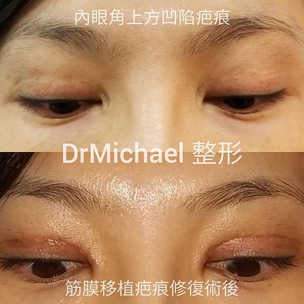 開眼頭凹陷疤痕 修復策略之二 筋膜 真皮 移植手術 作者沈筠惇 Dr Michael 的東方美學 沈筠惇醫師整形部落格 痞客邦
