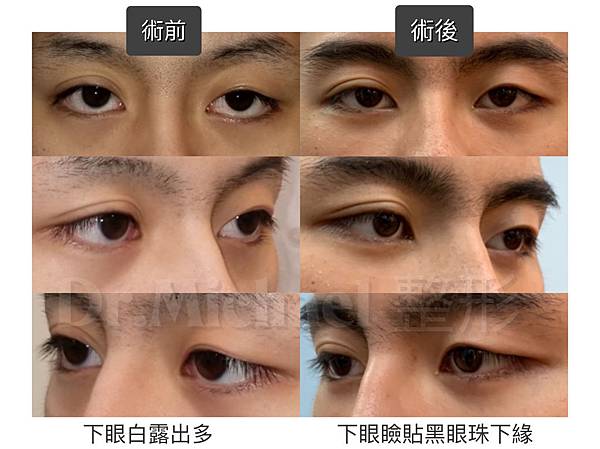 【眼白多、下三白】是不好的面相,如何改善下三白(下眼瞼退縮、 【眼白多、下三白】是不好的面相,如何改善下三白(下眼瞼退縮、