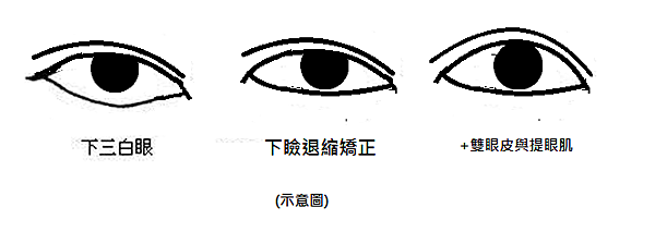 【眼白多、下三白】是不好的面相,如何改善下三白(下眼瞼退縮、 【眼白多、下三白】是不好的面相,如何改善下三白(下眼瞼退縮、