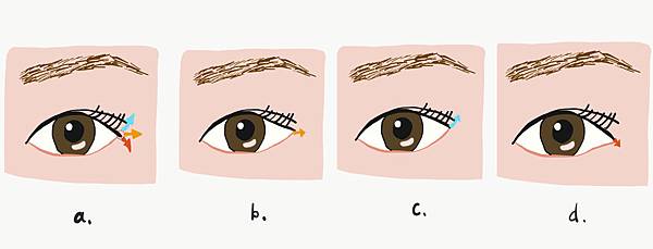 什麽是【開眼尾】手術?沈醫師的做法有什麽不同(眼尾韌帶移動手 什麽是【開眼尾】手術?沈醫師的做法有什麽不同(眼尾韌帶移動手