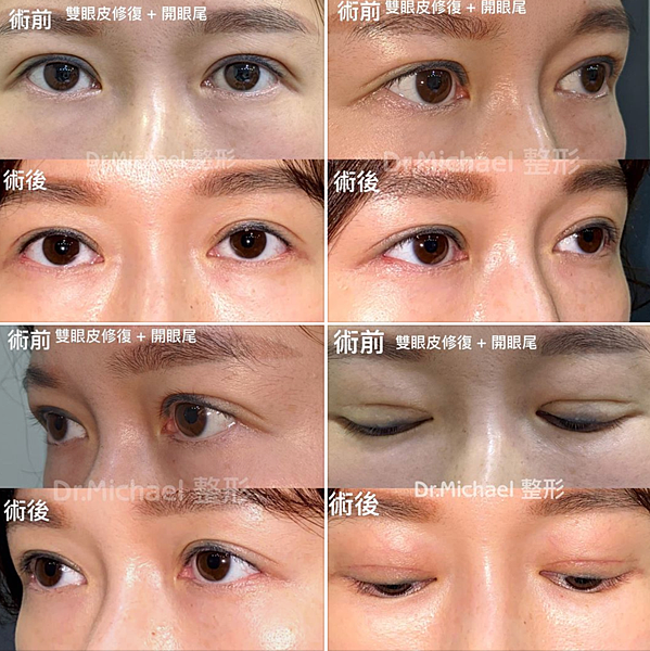 什麽是【開眼尾】手術?沈醫師的做法有什麽不同(眼尾韌帶移動手 什麽是【開眼尾】手術?沈醫師的做法有什麽不同(眼尾韌帶移動手
