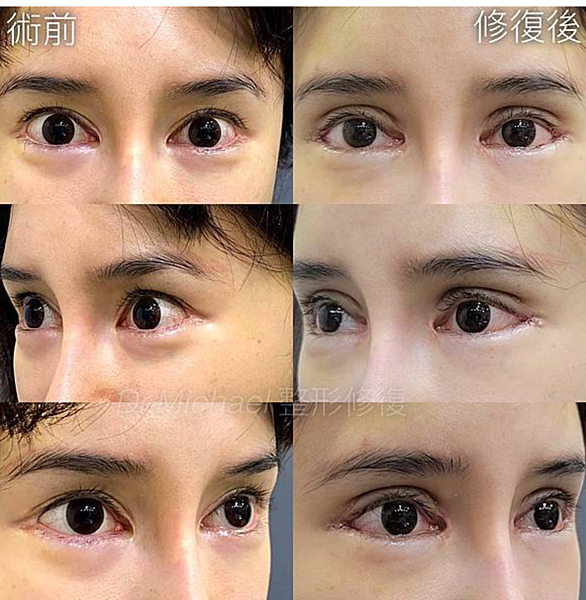 什麽是【開眼尾】手術?沈醫師的做法有什麽不同(眼尾韌帶移動手 什麽是【開眼尾】手術?沈醫師的做法有什麽不同(眼尾韌帶移動手