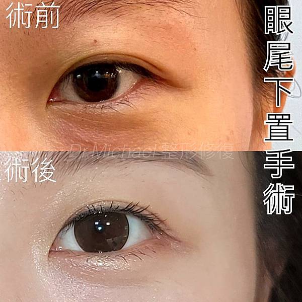 什麽是【開眼尾】手術?沈醫師的做法有什麽不同(眼尾韌帶移動手 什麽是【開眼尾】手術?沈醫師的做法有什麽不同(眼尾韌帶移動手