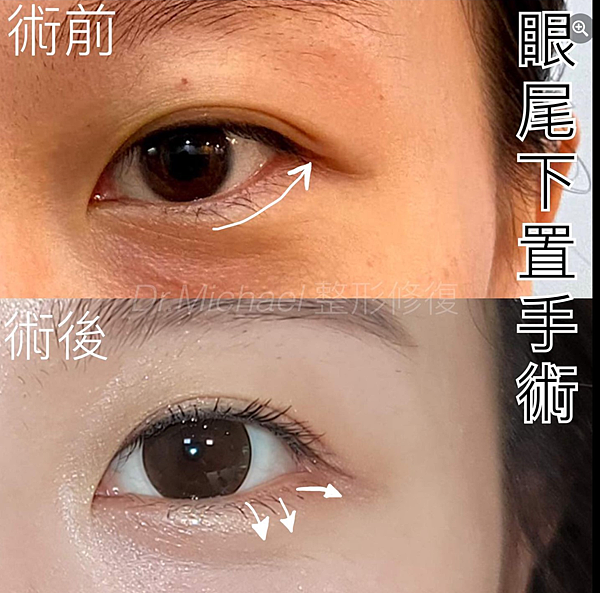 什麽是【開眼尾】手術?沈醫師的做法有什麽不同(眼尾韌帶移動手 什麽是【開眼尾】手術?沈醫師的做法有什麽不同(眼尾韌帶移動手