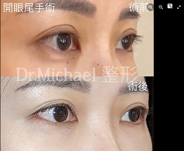 什麽是【開眼尾】手術?沈醫師的做法有什麽不同(眼尾韌帶移動手 什麽是【開眼尾】手術?沈醫師的做法有什麽不同(眼尾韌帶移動手
