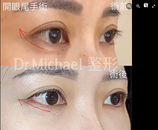 什麽是【開眼尾】手術?沈醫師的做法有什麽不同(眼尾韌帶移動手 什麽是【開眼尾】手術?沈醫師的做法有什麽不同(眼尾韌帶移動手