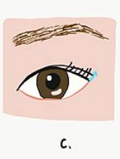 什麽是【開眼尾】手術?沈醫師的做法有什麽不同(眼尾韌帶移動手 什麽是【開眼尾】手術?沈醫師的做法有什麽不同(眼尾韌帶移動手