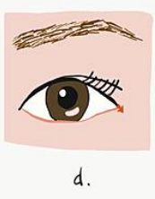 什麽是【開眼尾】手術?沈醫師的做法有什麽不同(眼尾韌帶移動手 什麽是【開眼尾】手術?沈醫師的做法有什麽不同(眼尾韌帶移動手