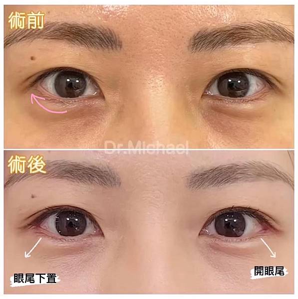 什麽是【開眼尾】手術?沈醫師的做法有什麽不同(眼尾韌帶移動手 什麽是【開眼尾】手術?沈醫師的做法有什麽不同(眼尾韌帶移動手