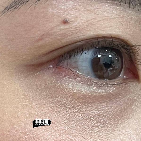 什麽是【開眼尾】手術?沈醫師的做法有什麽不同(眼尾韌帶移動手 什麽是【開眼尾】手術?沈醫師的做法有什麽不同(眼尾韌帶移動手