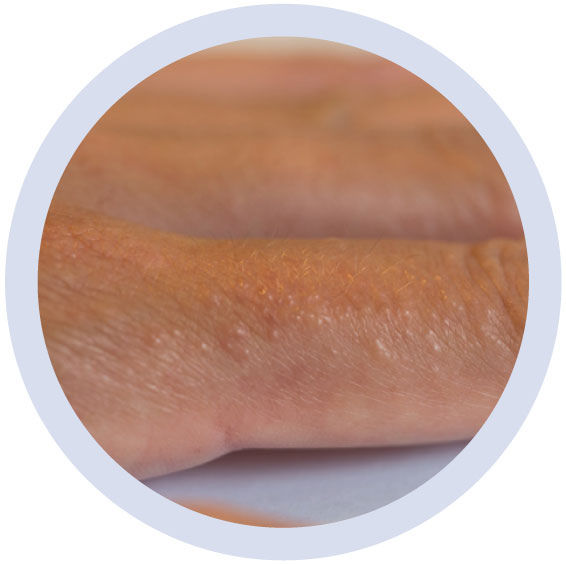 汗皰疹_1.jpg 汗皰疹_1.jpg